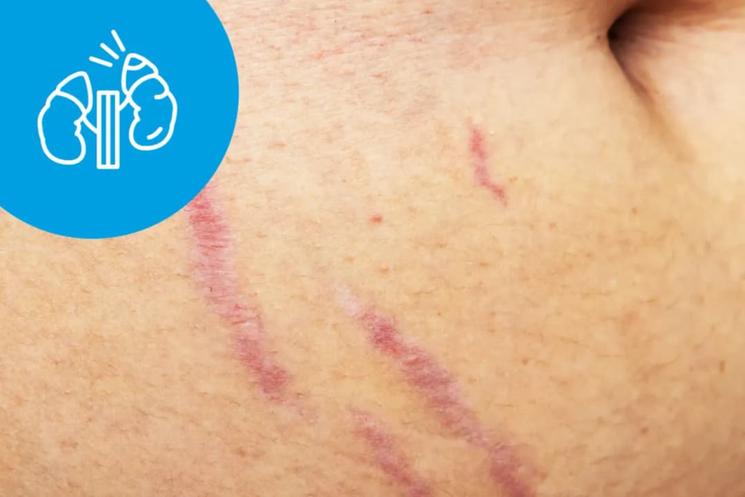 Zespół Cushinga – jakie badania potwierdzą diagnozę i co warto wiedzieć