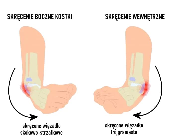 Ile leczy się skręcenie kostki? Poznaj skuteczne metody rehabilitacji
