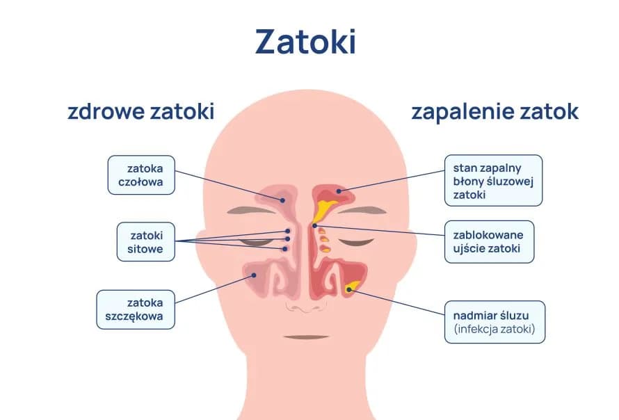 Jakiego lekarza wybrać przy zapaleniu zatok, aby uniknąć bólu?