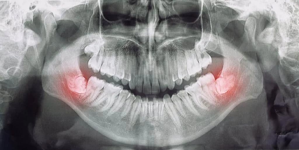 Gdzie z bólem zęba Chełm? Znajdź natychmiastową pomoc dentystyczną