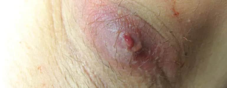 Czyrak do jakiego lekarza? Kluczowe informacje o leczeniu i objawach