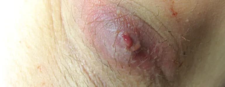 Czyrak do jakiego lekarza? Kluczowe informacje o leczeniu i objawach