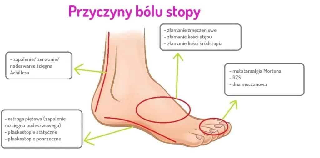 Ból śródstopia przyczyna: poznaj najczęstsze źródła dyskomfortu