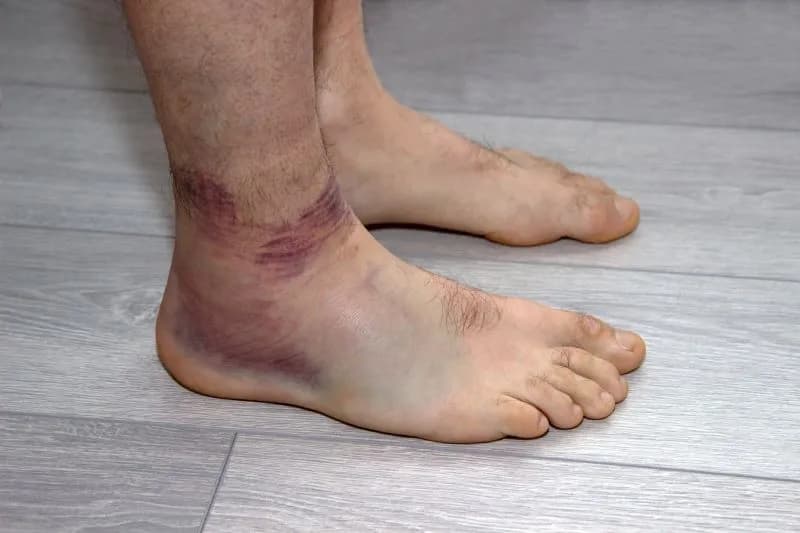 Jak wygląda skręcona kostka? Objawy, które musisz znać