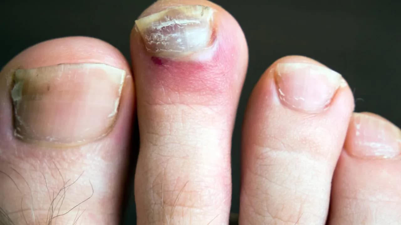 Wrastający paznokieć – jaki lekarz pomoże w skutecznym leczeniu?