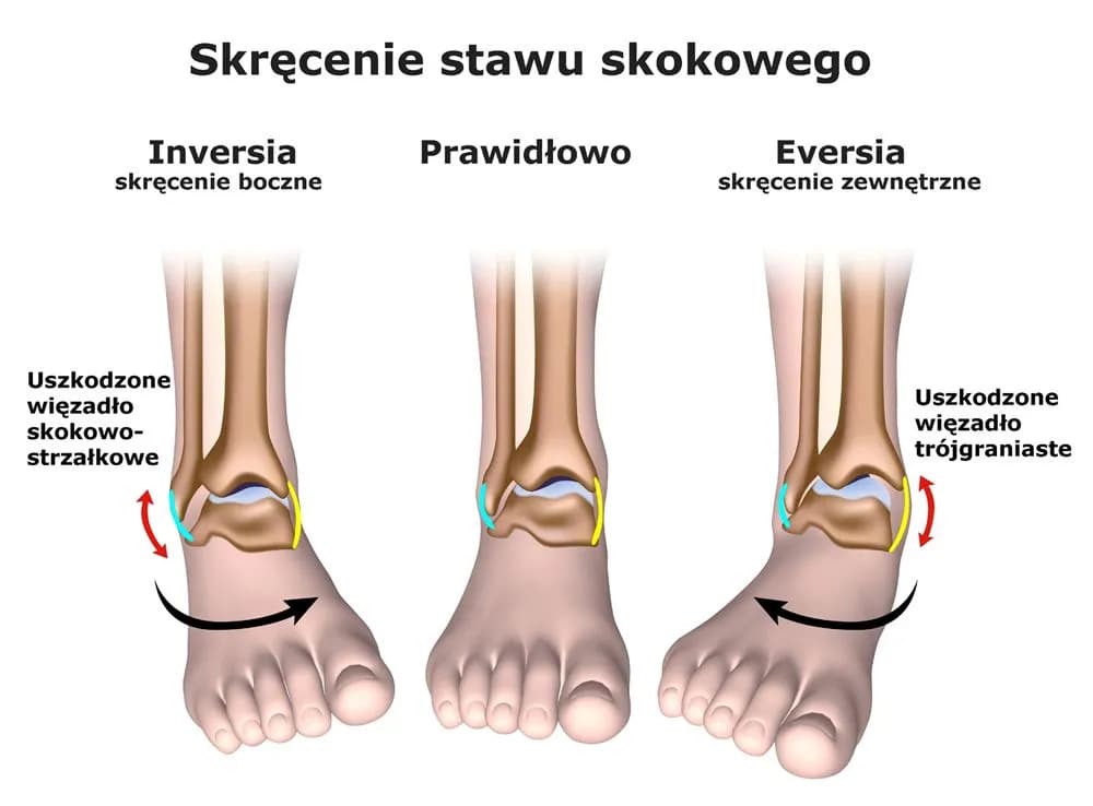 Objawy skręcenia: jak rozpoznać poważne kontuzje stawów