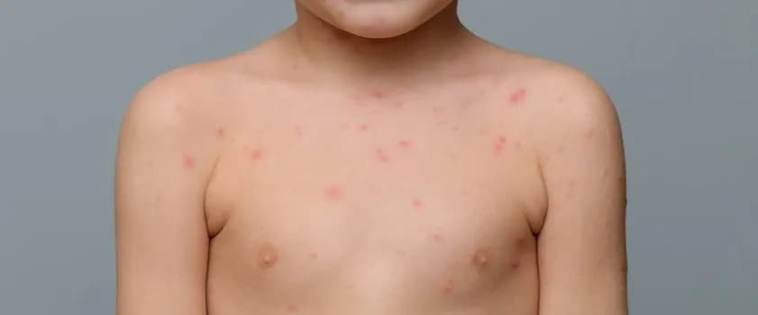 Kiedy do lekarza przy ospie? Kluczowe objawy, które musisz znać