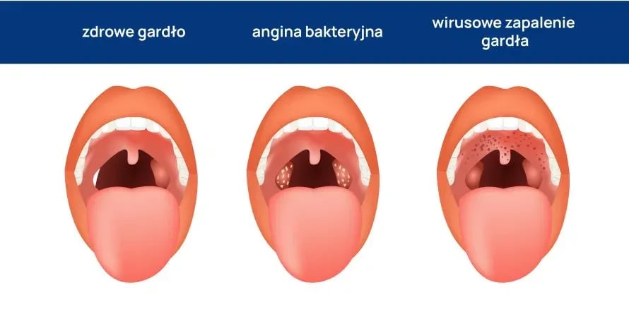 Jak złagodzić ból gardła przy anginie – skuteczne metody i porady