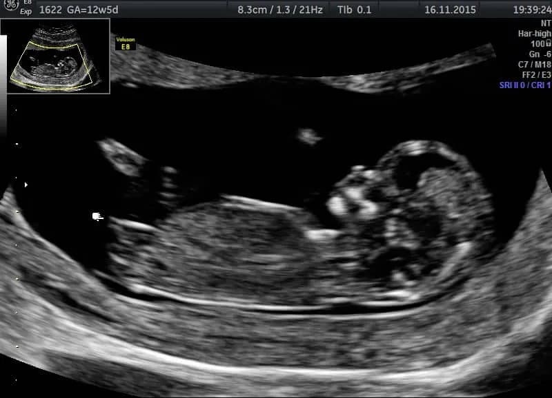 Jak wyglądają badania prenatalne w 13 tygodniu ciąży i co warto wiedzieć