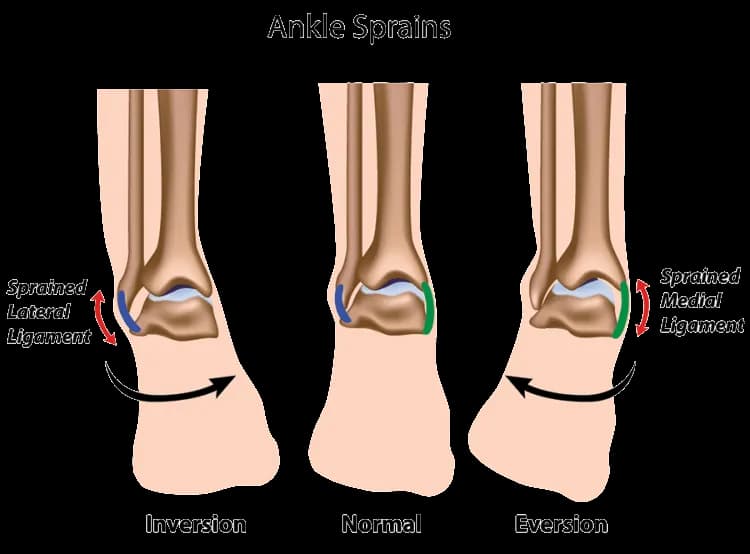 Skręcenie kostki 1 stopnia ile trwa? Oto co musisz wiedzieć o leczeniu