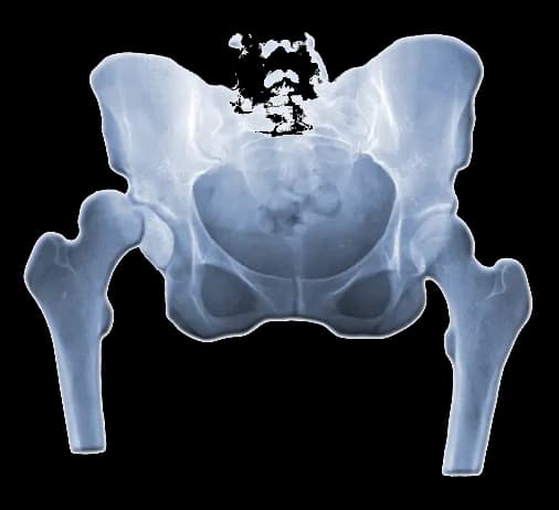 Skręcenie stawu biodrowego objawy – jak je rozpoznać i leczyć