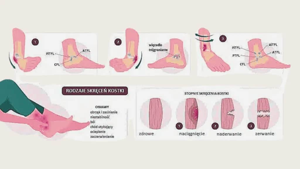 Co jest gorsze: zwichnięcie czy skręcenie? Prawda o urazach
