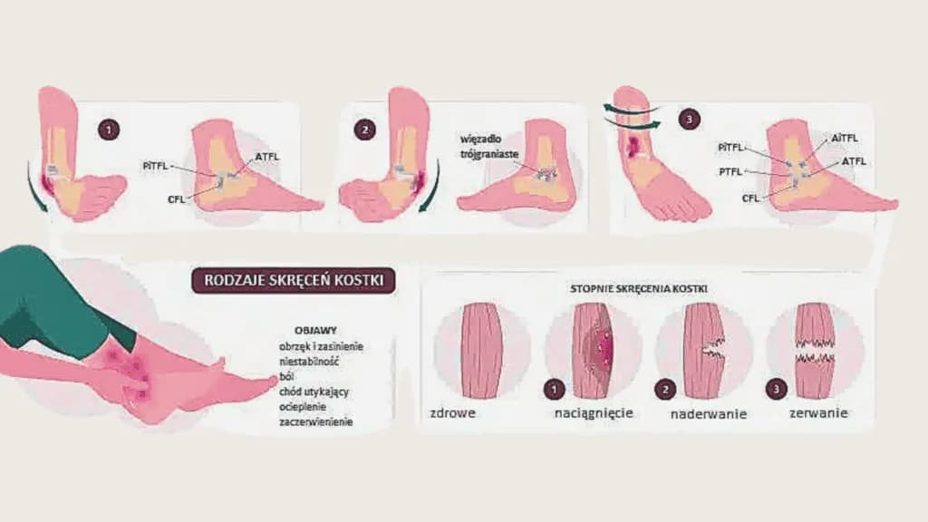 Co jest gorsze: zwichnięcie czy skręcenie? Prawda o urazach