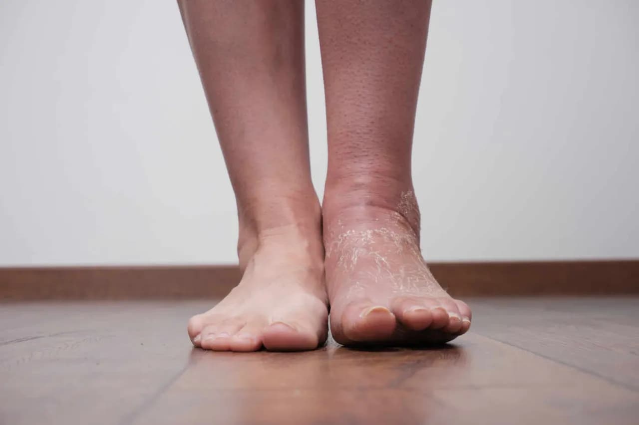 Jak długo trwa opuchlizna po skręceniu kostki? Sprawdź ważne informacje