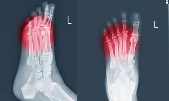 Skręcenie śródstopia objawy - jak rozpoznać ból i obrzęk stopy